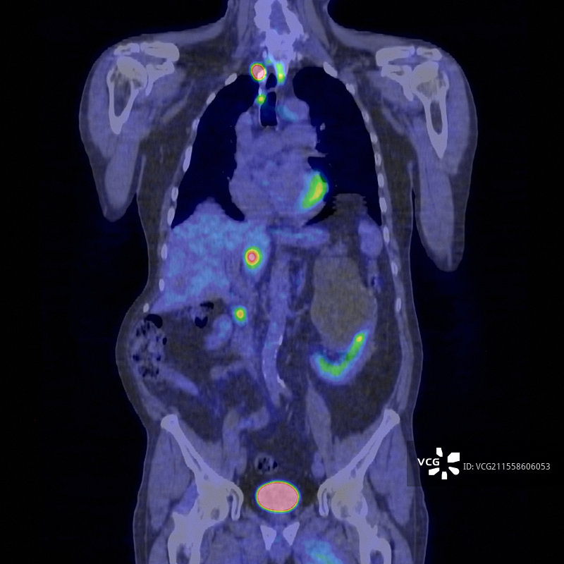 继发性癌症，PET扫描图片素材