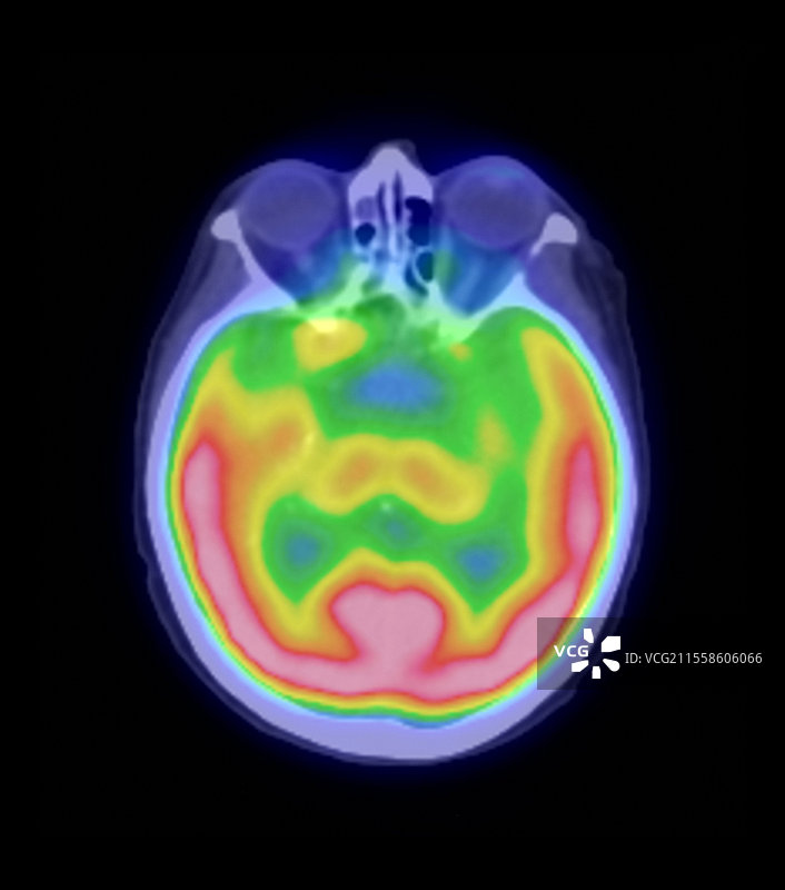 人脑，正电子发射断层扫描图片素材