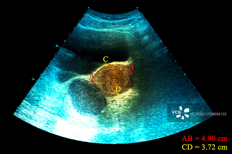 子宫内膜异位囊肿，超声扫描图片素材