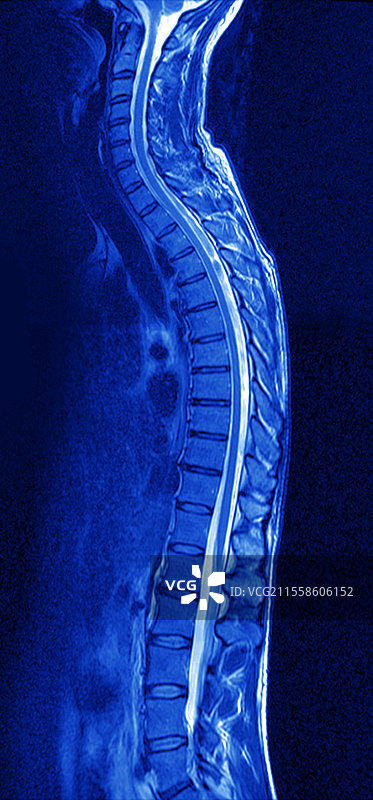 正常脊柱，MRI扫描图片素材