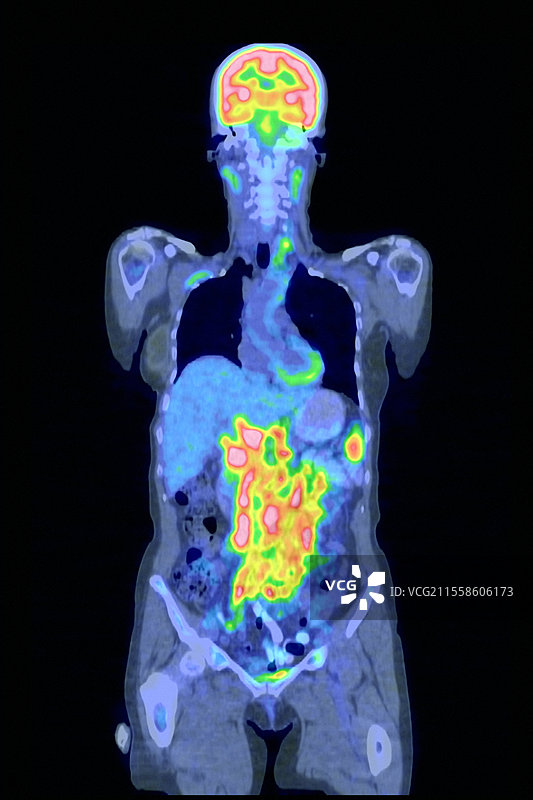 非霍奇金淋巴瘤，CT和PET扫描图片素材