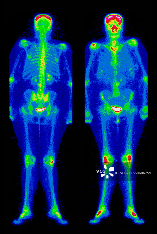肥胖，放射性核素扫描图片素材