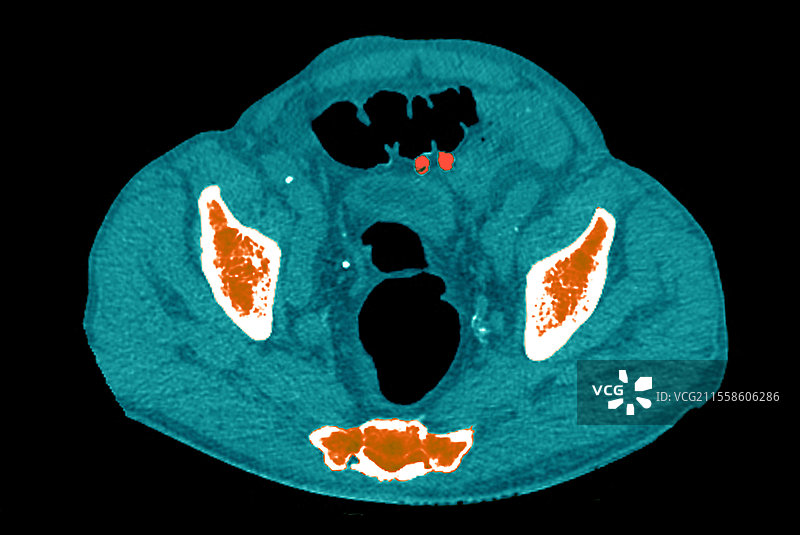 憩室病，CT扫描图片素材