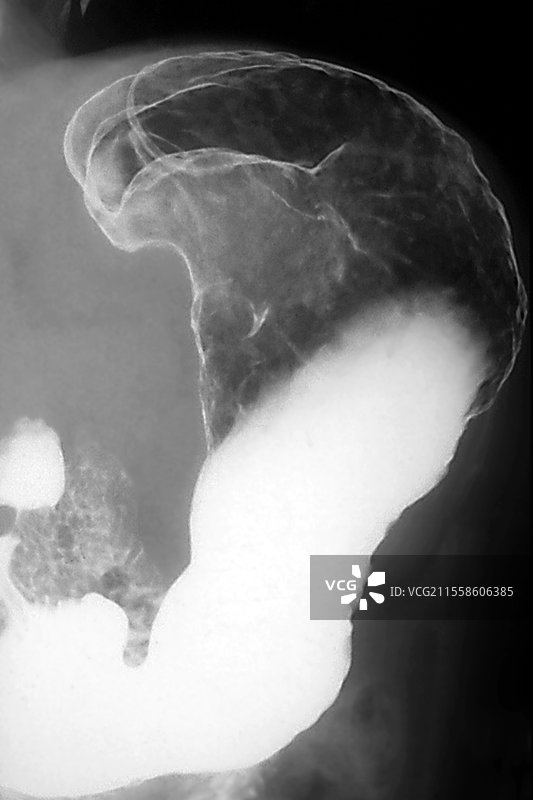 胃癌，钡餐X光检查图片素材