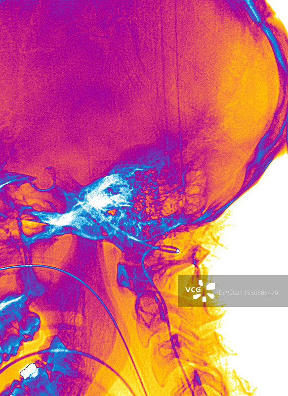 脑死亡，血管造影图片素材
