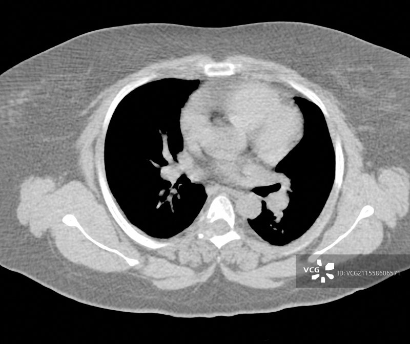 朗格汉斯细胞组织细胞增生症，CT扫描图片素材