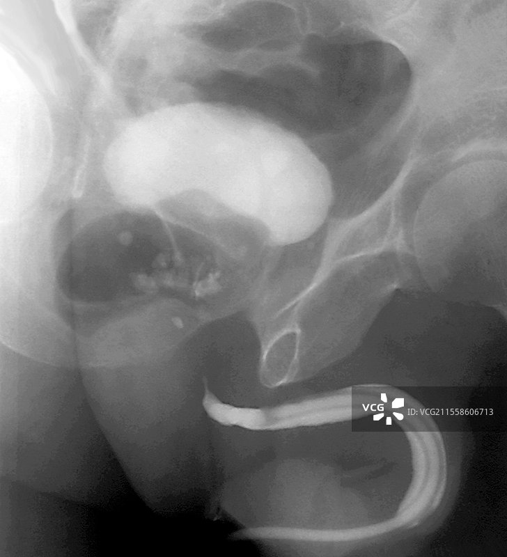 前列腺中的结石，X光检查图片素材
