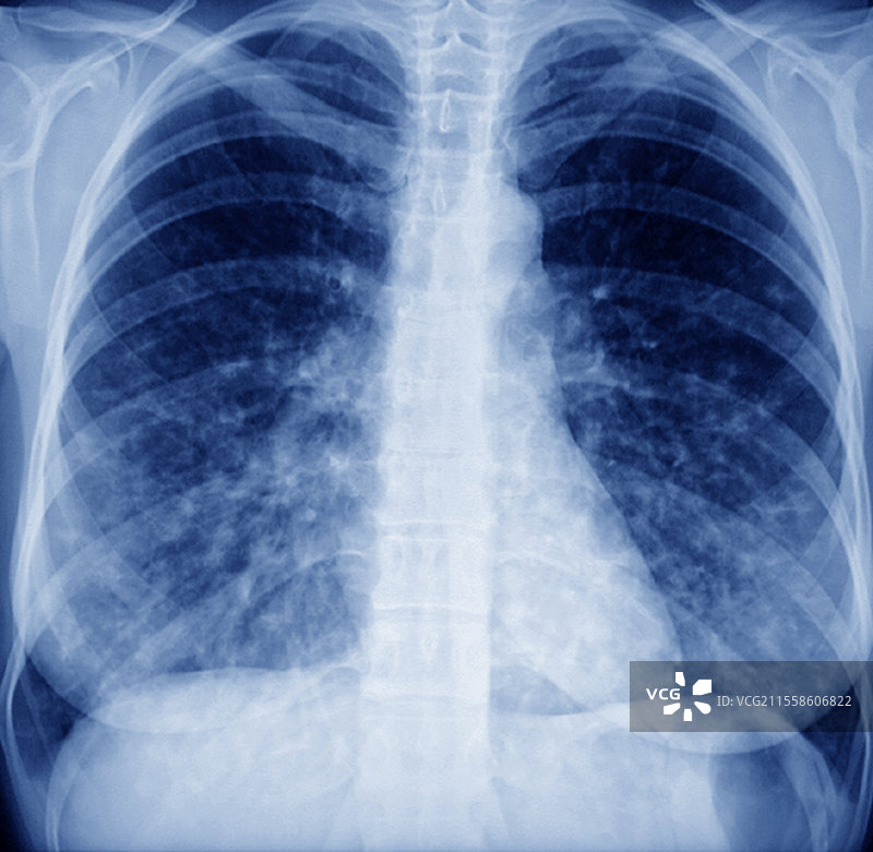 组织细胞增生症中的肺结节，X光片图片素材