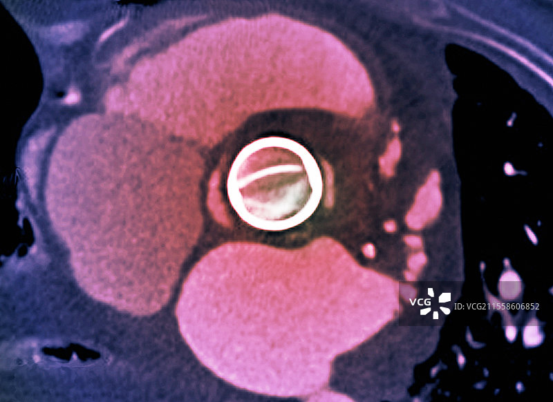 心脏瓣膜植入，CT扫描图片素材