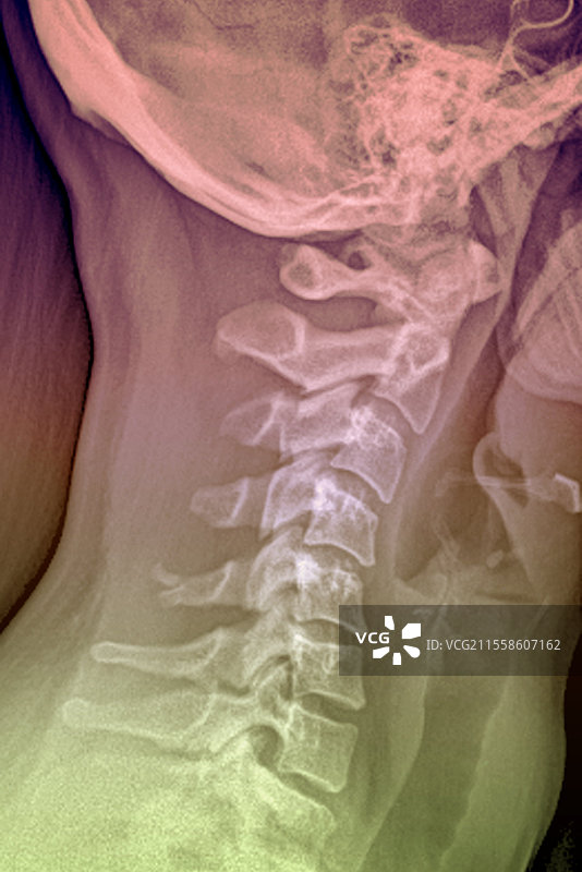 颈部反向鞭打伤，X光片图片素材
