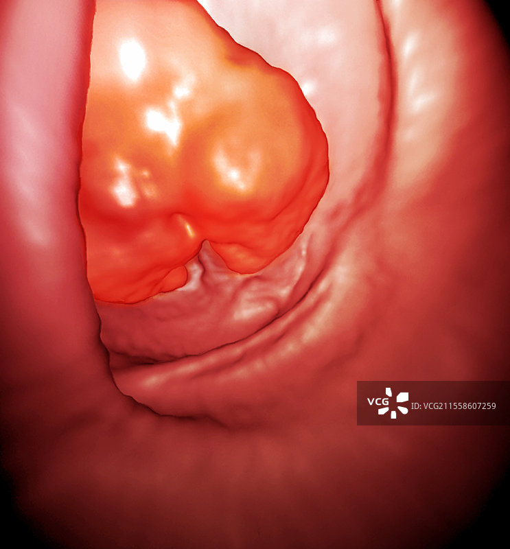 直肠癌，3D CT扫描图片素材
