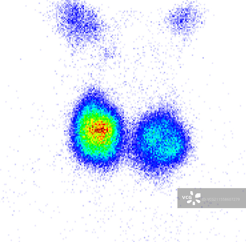 甲状腺腺瘤，显像图图片素材