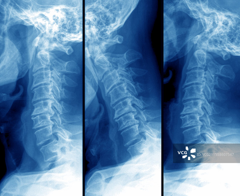 颈椎关节炎，X光片图片素材