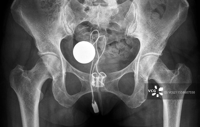 人工尿道括约肌，X光图片素材
