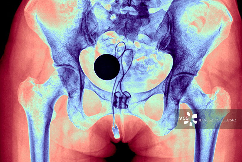 人工尿道括约肌，X光图片素材