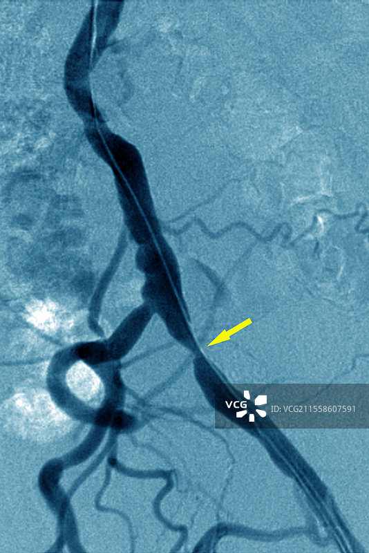 髂动脉狭窄，X光片图片素材