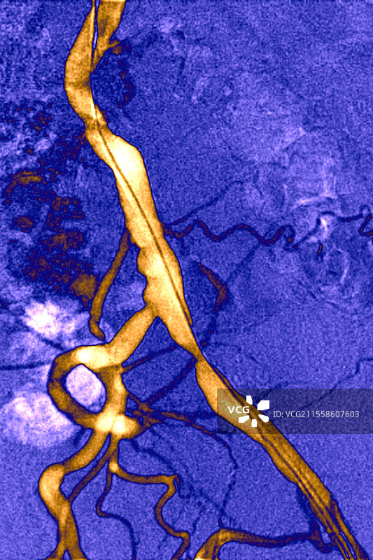 髂动脉狭窄，X光片图片素材