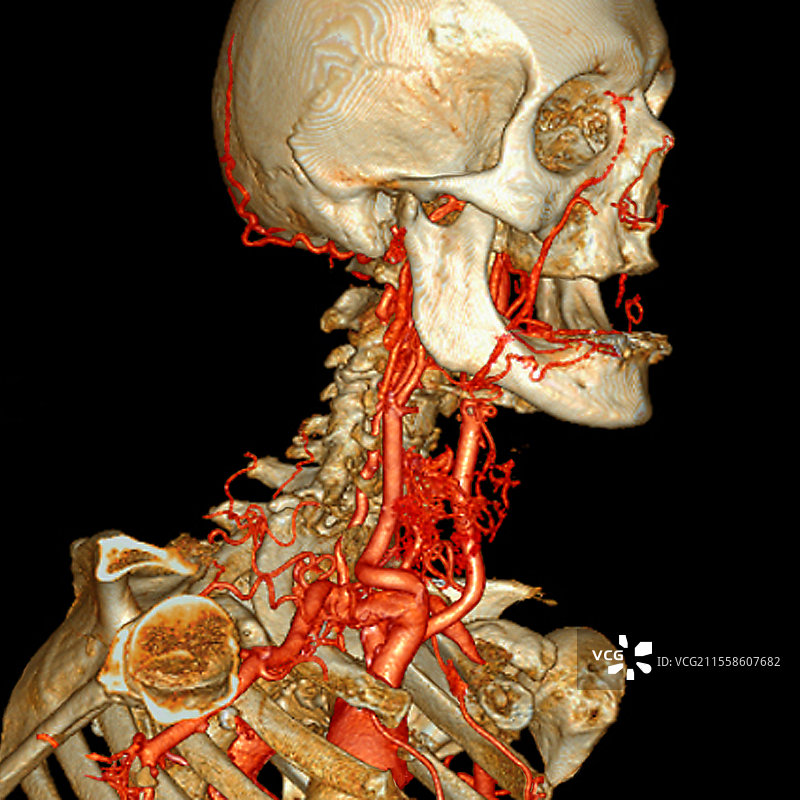 颈部和头部动脉，3D血管造影CT扫描图片素材