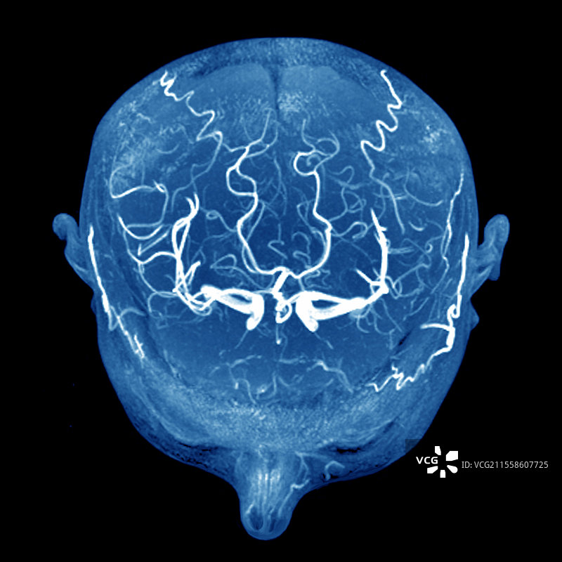 健康的大脑动脉，3D MRI扫描图片素材