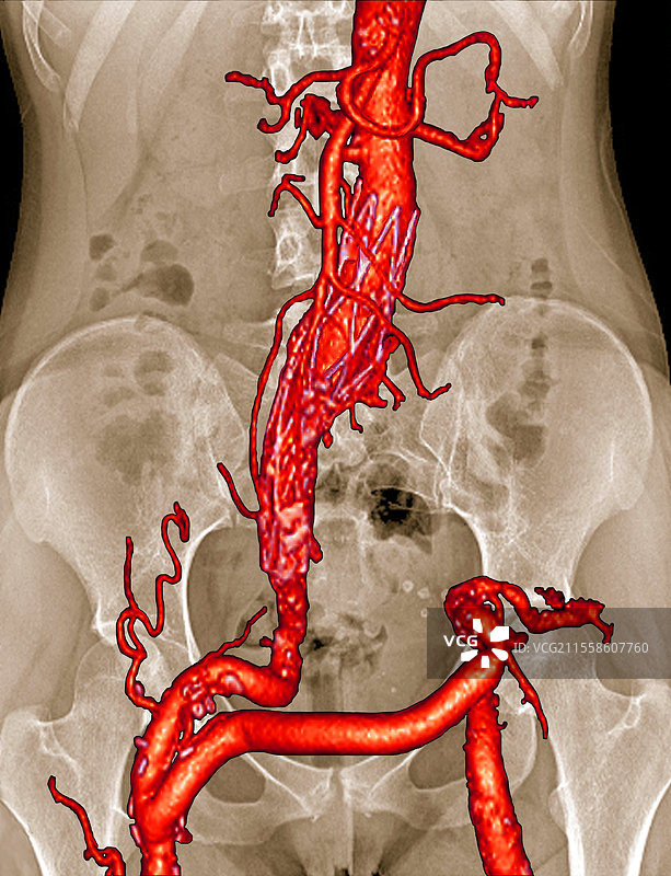 支架和动脉旁路，3D血管造影CT扫描图片素材