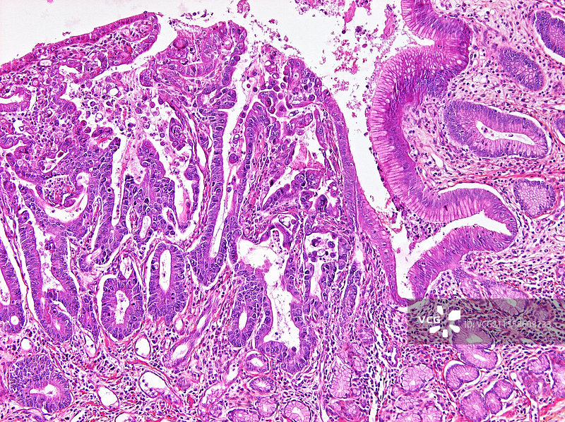 胃癌，光学显微镜图像图片素材