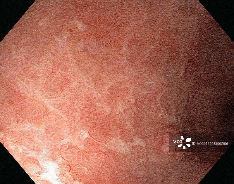 溃疡性结肠炎图片素材