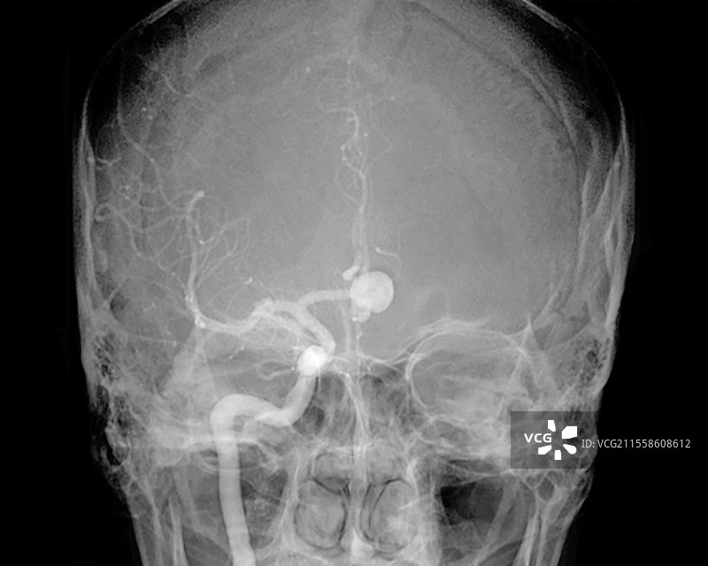 脑动脉瘤，X光检查图片素材
