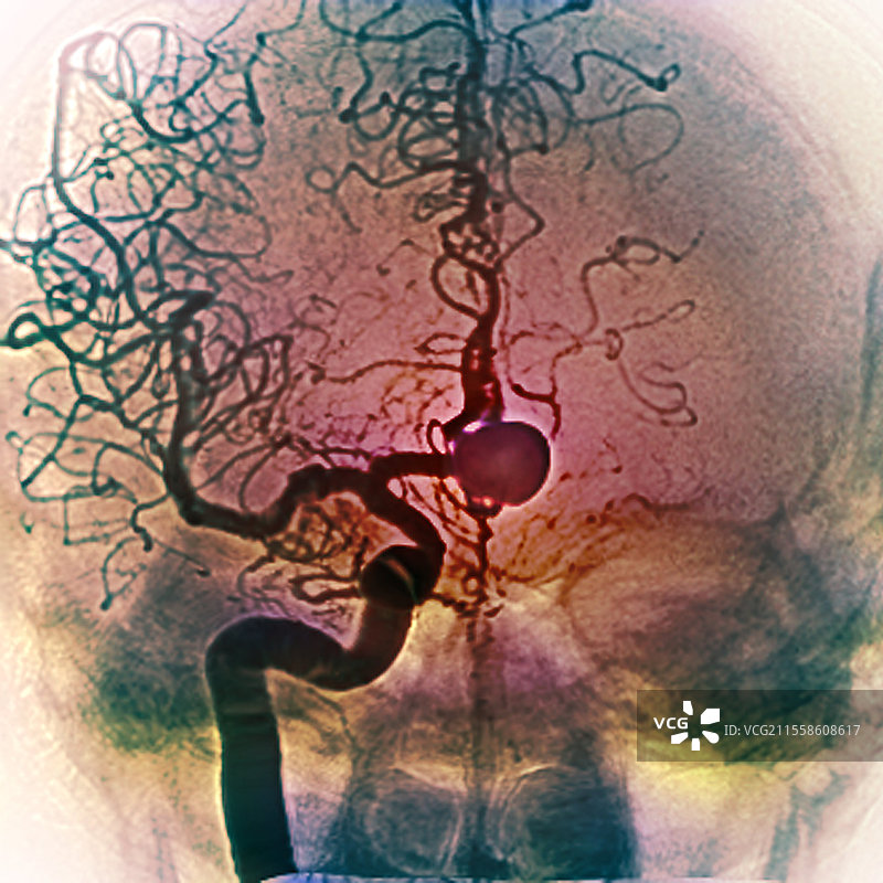 脑动脉瘤，X光检查图片素材