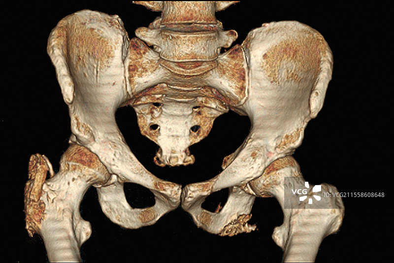 良性骨肿瘤，CT扫描图片素材