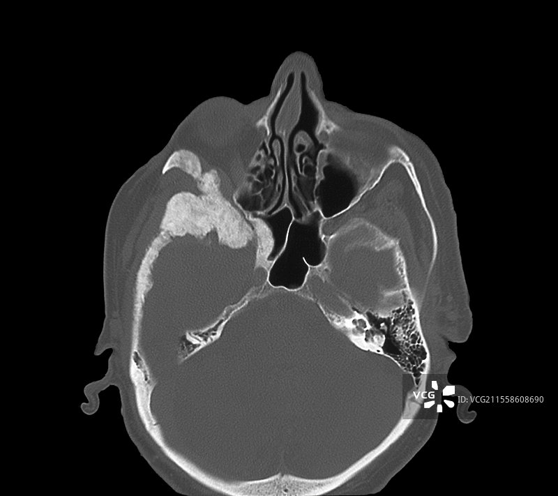 转移性骨癌，CT扫描图片素材
