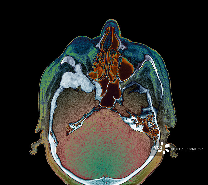 转移性骨癌，CT扫描图片素材