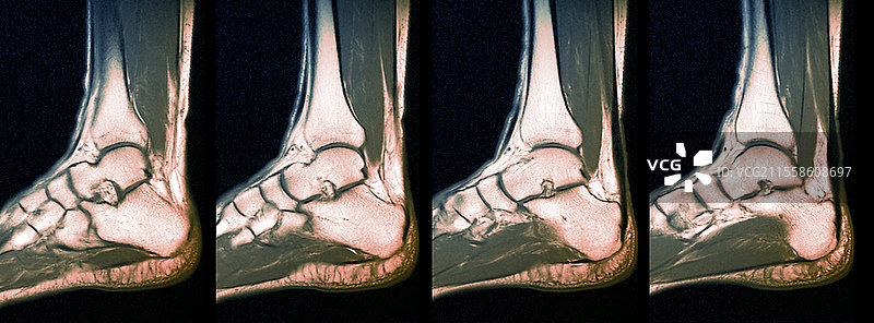 正常踝关节，MRI扫描图片素材