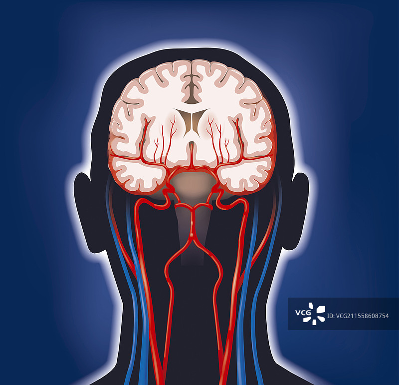 脑出血，艺术作品图片素材