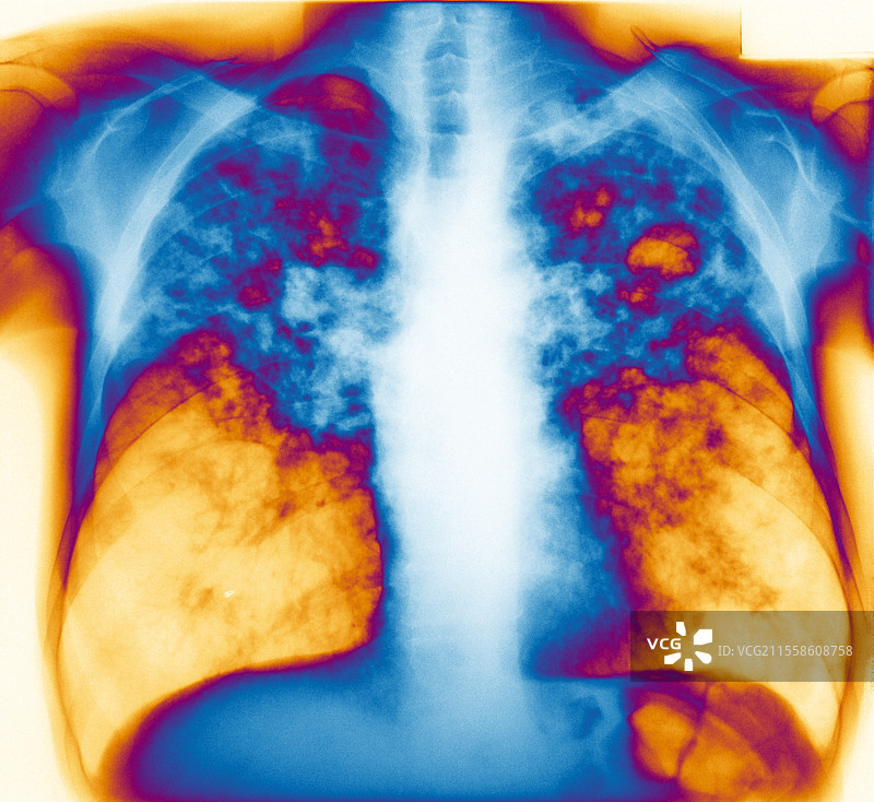 结核病，X光检查图片素材