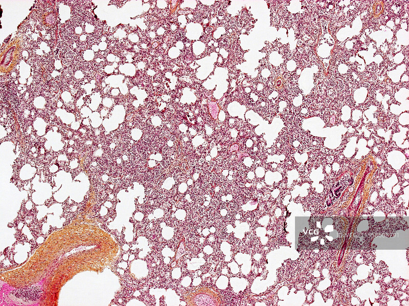 支气管肺炎，光学显微镜下图像图片素材