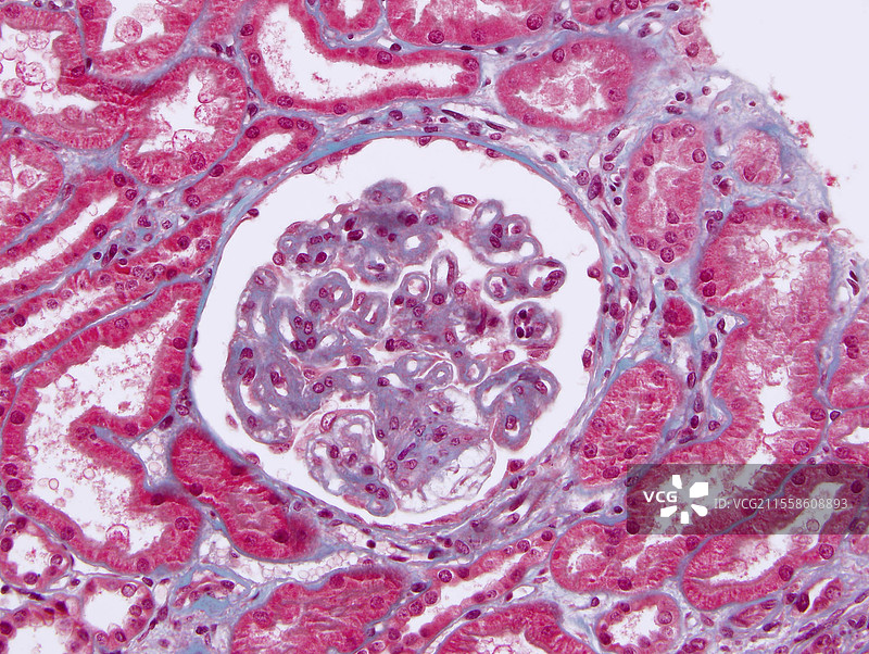 肾小球肾炎，光学显微镜下的图像图片素材