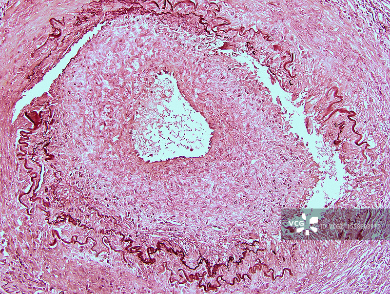 霍顿病，光学显微镜图像图片素材