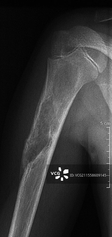 纤维性骨营养不良，X光片图片素材