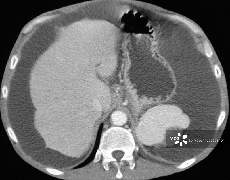 腹水，CT扫描图片素材