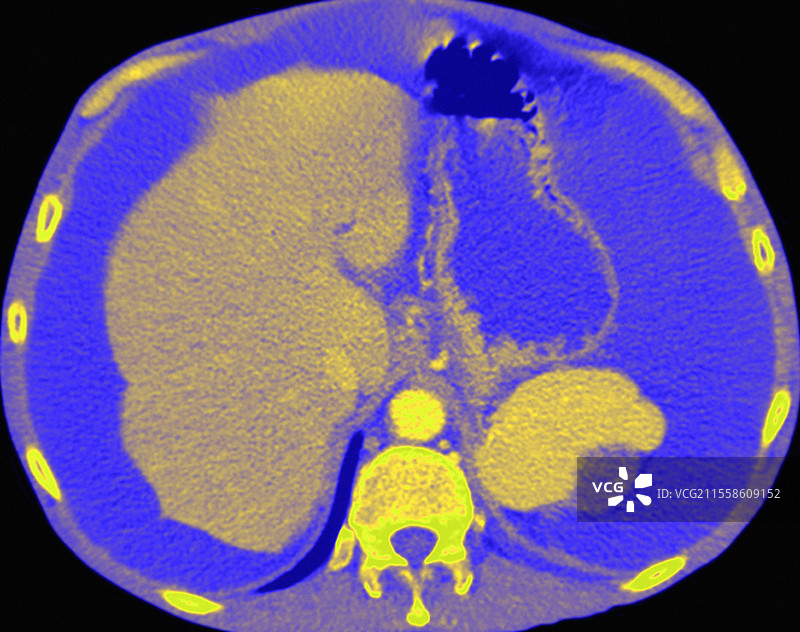 腹水，CT扫描图片素材