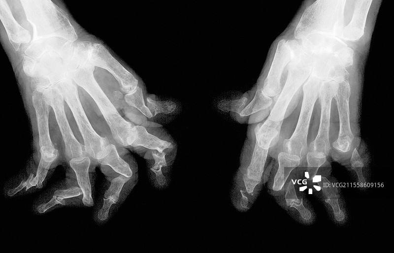 银屑病关节炎，X光检查图片素材