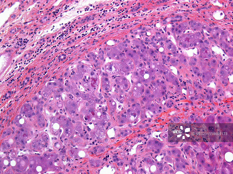 酒精性肝硬化，光学显微镜图像图片素材