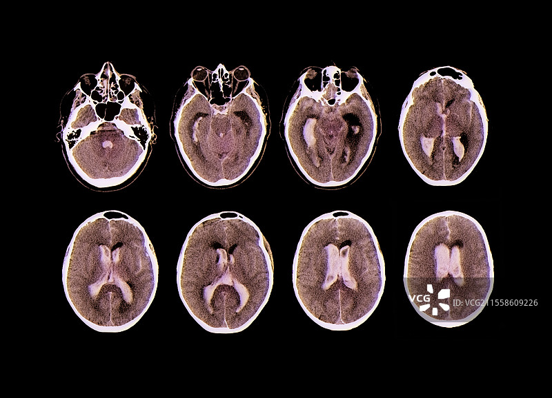脑出血，CT扫描图片素材