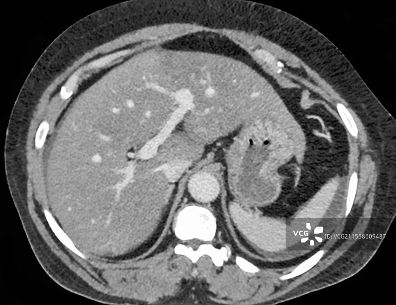 肝肿大，CT扫描图片素材