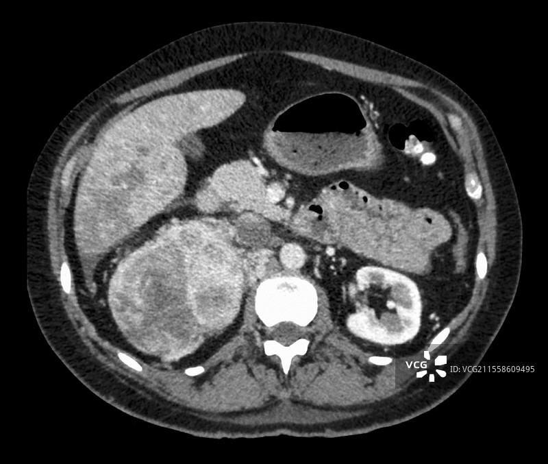 肾癌图片素材