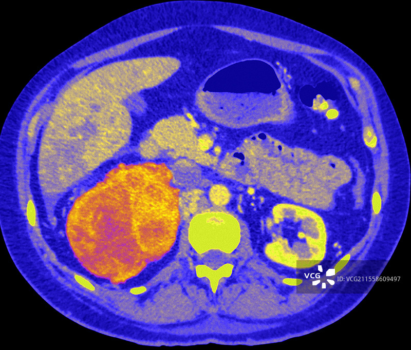 肾癌图片素材
