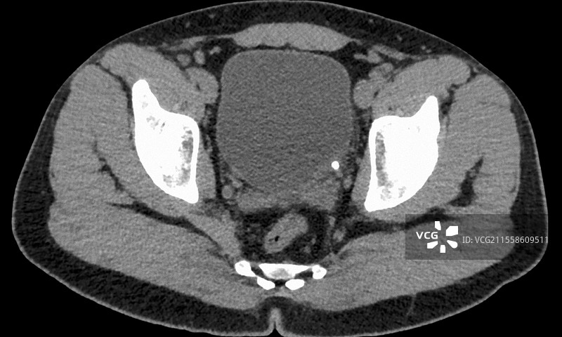 膀胱结石，CT扫描图片素材