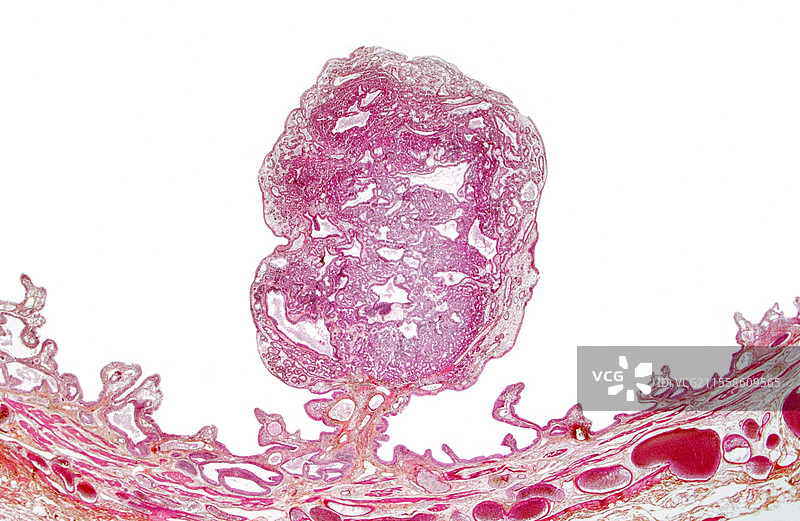 胆囊息肉，光学显微镜图像图片素材