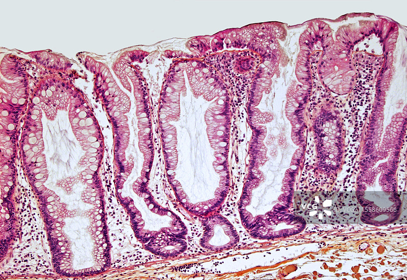 结肠癌，光学显微镜图像图片素材