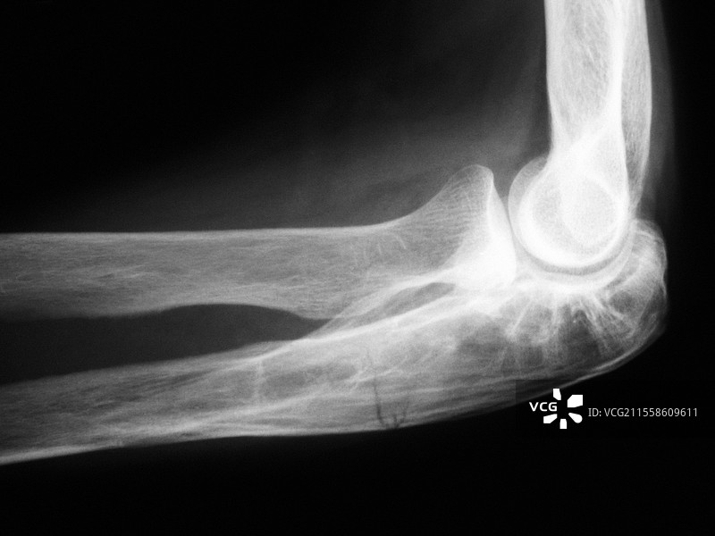 骨骼的佩吉特病，X光片图片素材